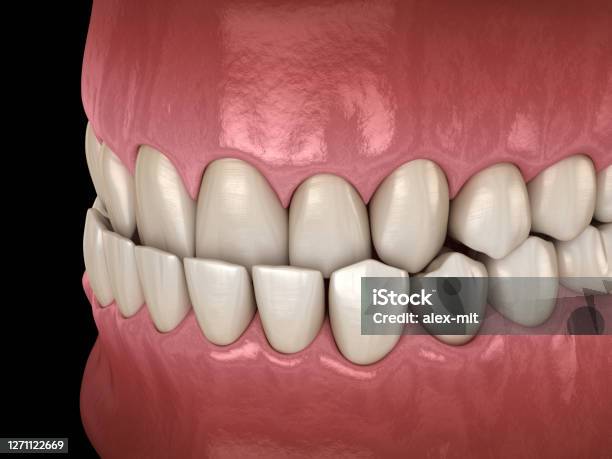 Unterbiß Dental Okklusion Medizinisch Genaue Zahn 3dillustration Stockfoto und mehr Bilder von Fehlbiss