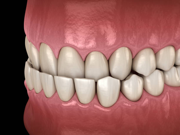 istock Underbite dental occlusion ( Malocclusion of teeth ). Medically accurate tooth 3D illustration 1271122669
