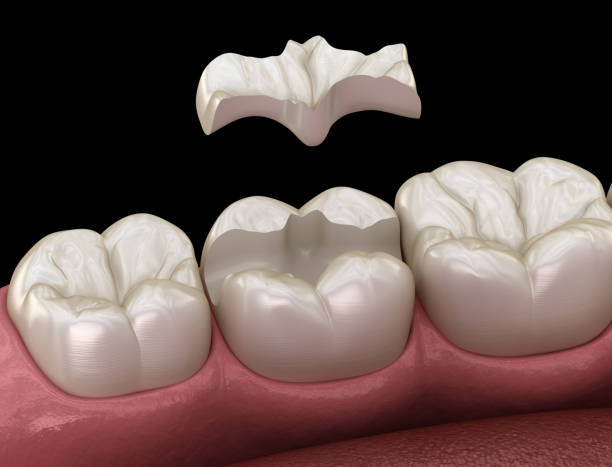 istock Inlay ceramic crown fixation over tooth. Medically accurate 3D illustration of human teeth treatment 1271122693