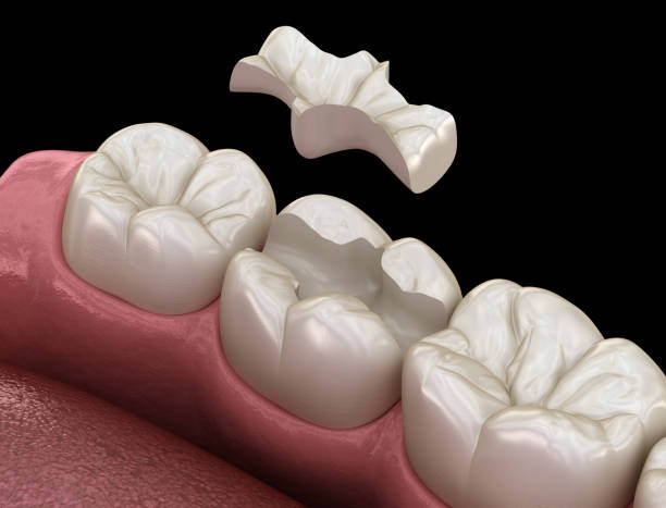 istock Inlay ceramic crown fixation over tooth. Medically accurate 3D illustration of human teeth treatment 1271122696