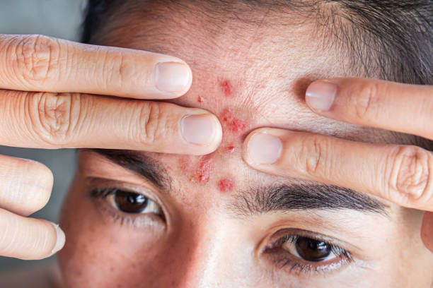 istock Asian woman having skin problem with acne face ,squeezing pimples on her forehead 1271248414