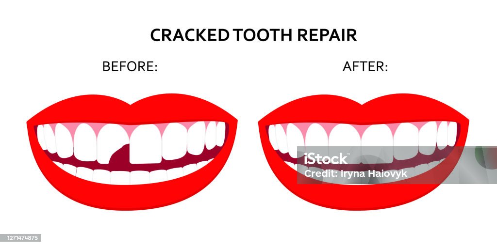 Illustration Of Cracked Tooth Repair Smile Mouth With Cracked Tooth Before  And After Repair Vector Isolated On White Background Good For Posters  Banners Infographic Eps10 Stock Illustration - Download Image Now - iStock