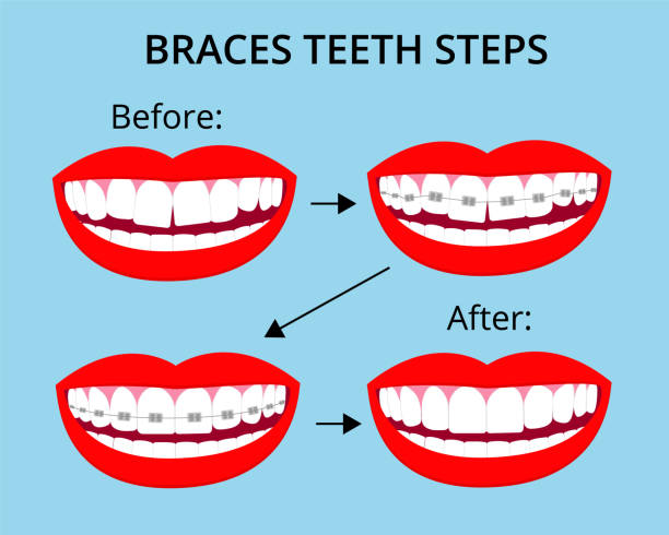 istock Steps of braces orthodontic treatment on smile mouth with white teeth. Before and after. Vector isolated elements. EPS10 1271475388