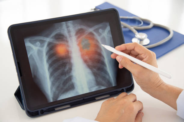 lung pneumonia x-ray - x ray image radiologist examining using voice imagens e fotografias de stock