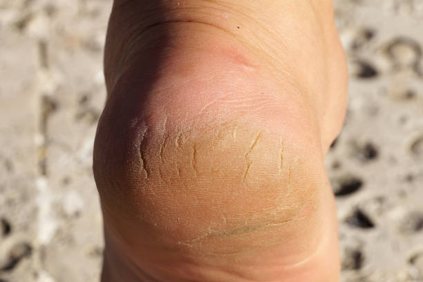 istock female heel with deep cracks close up 1271669596