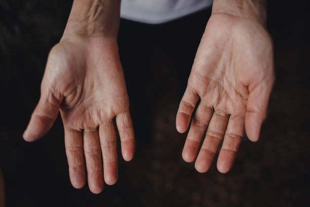 istock Dry hands of a woman. Hand skin problem 1271683296