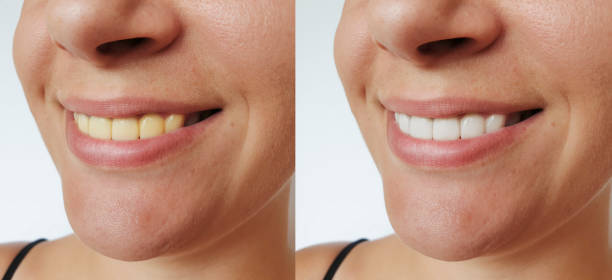 istock Smiling woman before and after teeth whitening procedure 1271749803