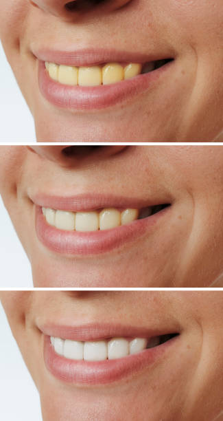 istock Smiling woman before and after teeth whitening procedure 1271754471
