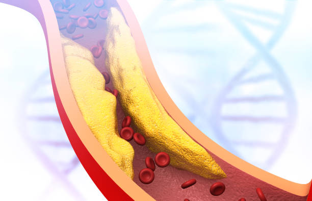 istock Clogged arteries. arterial plaque 1271875885