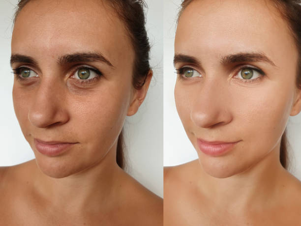 istock woman face wrinkles before and after treatment collage 1271896587