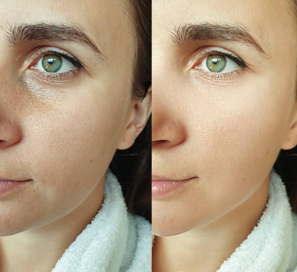 istock woman face wrinkles before and after treatment collage 1271920583