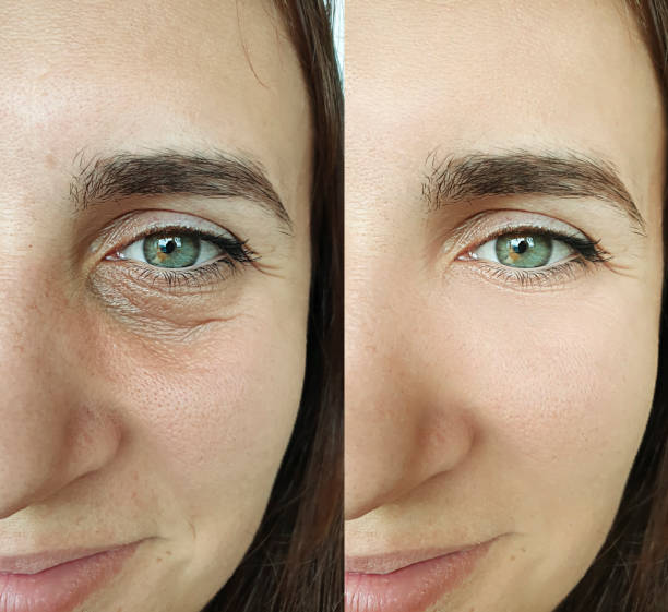 istock woman face wrinkles before and after treatment collage 1271987949