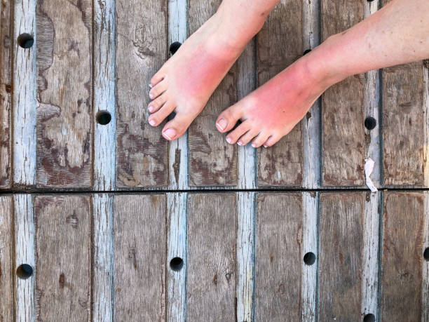 sun burned feet of a woman stock photo