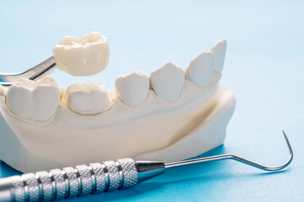 Prosthodontics or Prosthetic Closeup / Prosthodontics or Prosthetic / Single teeth crown and bridge equipment model express fix restoration. dental crown stock pictures, royalty-free photos & images