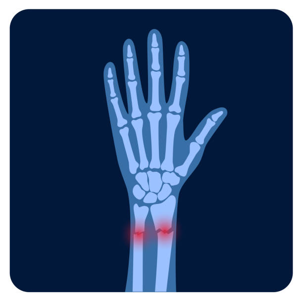 Fracture x ray concept X ray of arm fracture with red pain or inflammation points. Broken hand with Inner closed radius type of fracture. Human skeleton anatomy concept. Medical banner for clinic. Flat vector illustration. broken bone x ray stock illustrations