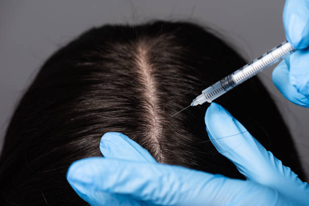 nahaufnahme ansicht der brünetten frau mit kopfhaut mesotherapie isoliert auf schwarz - female color image human head studio shot stock-fotos und bilder