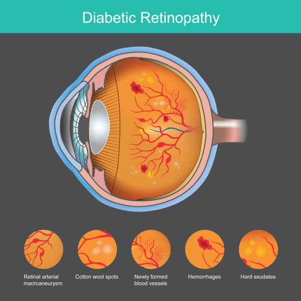 Diabetic Retinopathy. Illustration abnormality the retina from symptoms the diabetic retinopathy."n vector art illustration