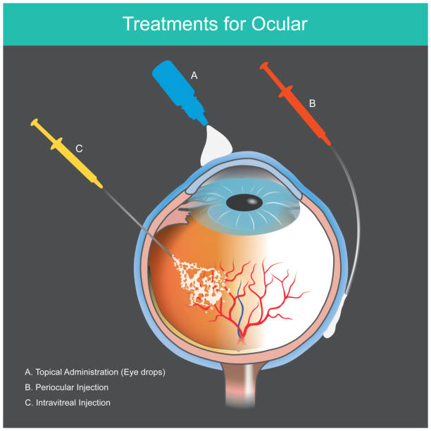 Treatments for Ocular. Illustration explain treatment of retinal diseases caused by blood vessel abnormal of the eye."n vector art illustration