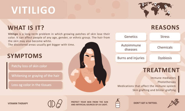 Infographics of vitiligo. Causes of the disease. Abstract woman silhouette. Vector concept to support people living with vitiligo and to build awareness about chronic skin disorder. Self care. Infographics of vitiligo. Causes of the disease. Abstract woman silhouette. Vector concept to support people living with vitiligo and to build awareness about chronic skin disorder. Self care vitiligo stock illustrations