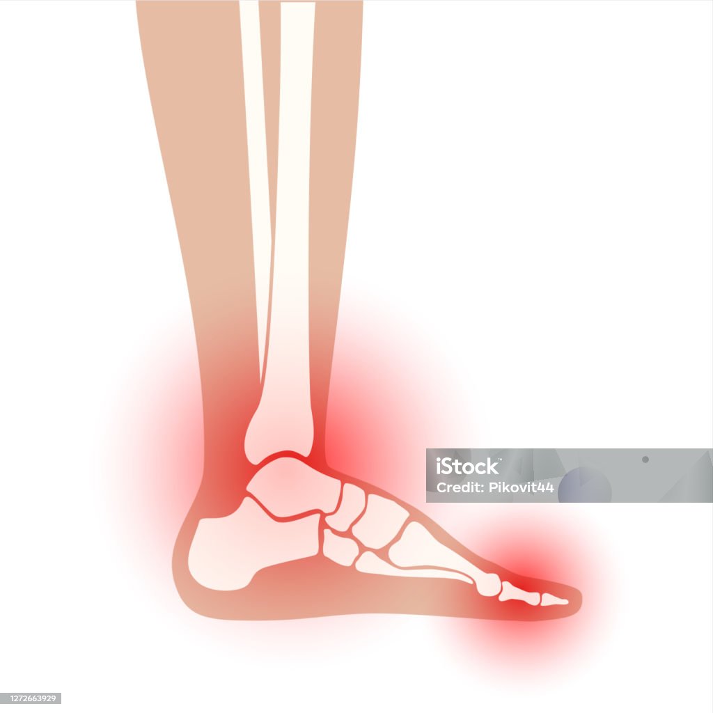 Arthritis Foot Stock Illustration - Download Image Now - Anatomy, Ankle ...