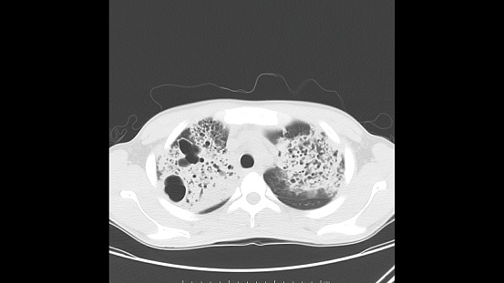 Axial computed Tomography of the chest (lung window) in a known patient of Active Tuberculosis (TB) showing pneumonia and cavitation in both lungs