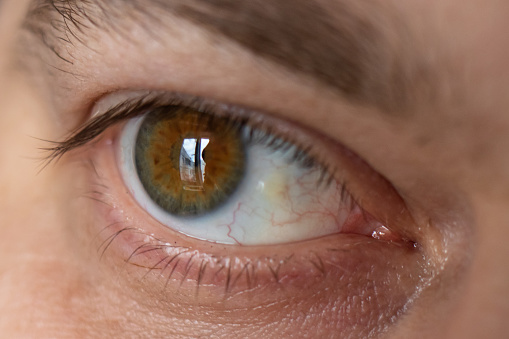 Ojos pinguecula macro foto primer plano del ojo masculino. Educación amarilla sobre ardilla, ojo de granjero photo