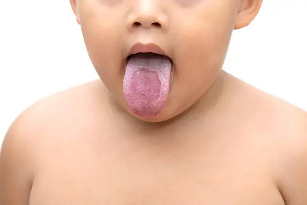 The little boy stuck out his tongue, showing signs of white tongue. Caused by mold or bacteria