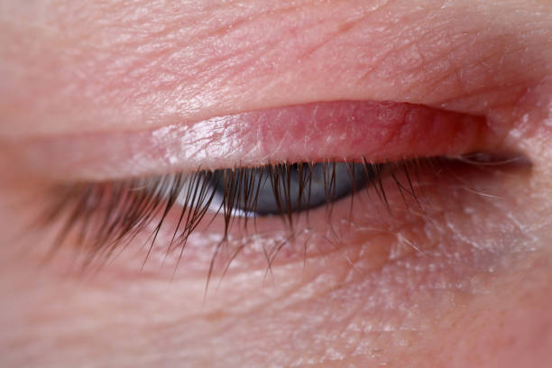 istock Sty on human eye closeup skin disease 1272956784