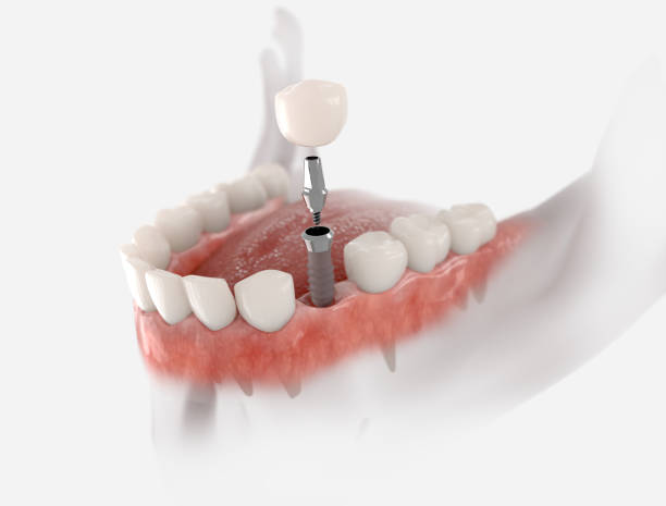 premolar tandimplantaat - tanden illustraties stockfoto's en -beelden