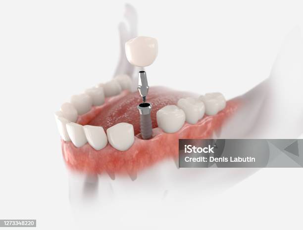 Premolar Tooth Implant Stock Photo - Download Image Now - Dental Implant, Dental Health, Implant