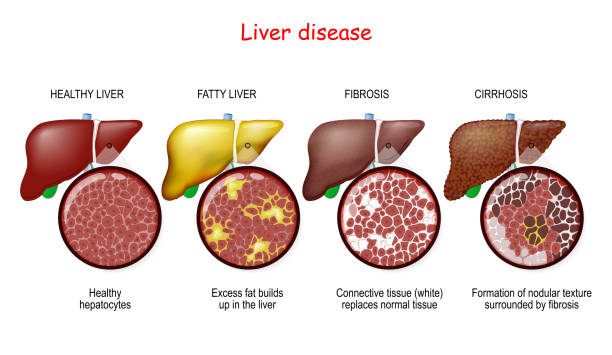Liver diseases. Stages of liver damage Liver diseases. Stages of liver damage from healthy liver to fatty, fibrosis, and cirrhosis. Close-up of histology tissue anatomy stock illustrations