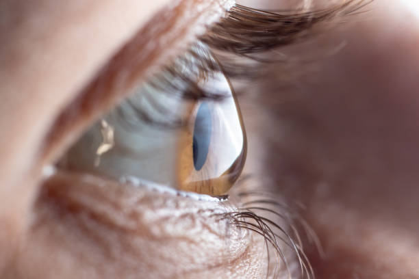 눈의 매크로 그림입니다. 원뿔의 형태로 각막, 눈 각막의 질병. - human eye eyesight optometrist lens 뉴스 사진 이미지
