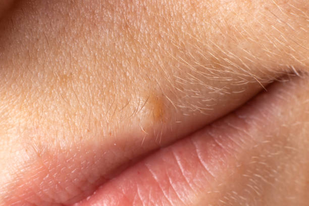 istock A mole near the upper lip. Nevus macro close up. 1273459096