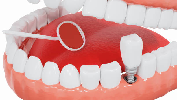 istock Dental Implants surgery concept, dentistry denture, Dental denture on white background. 3D render. 1273461205