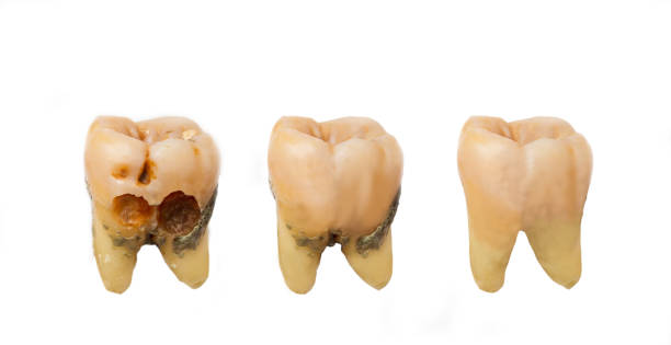 istock Tooth character show stages of caries development. 1273580293