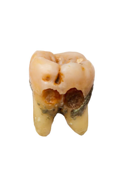istock Tooth character show stages of caries development. 1273580295