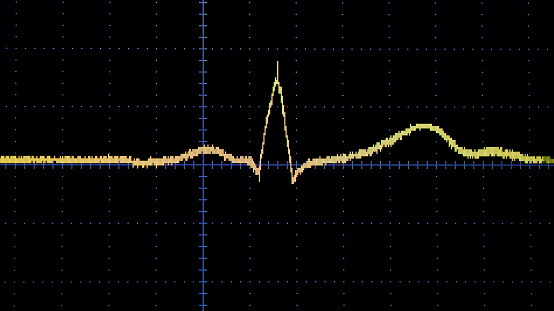 Baseline ECG on black Screen.