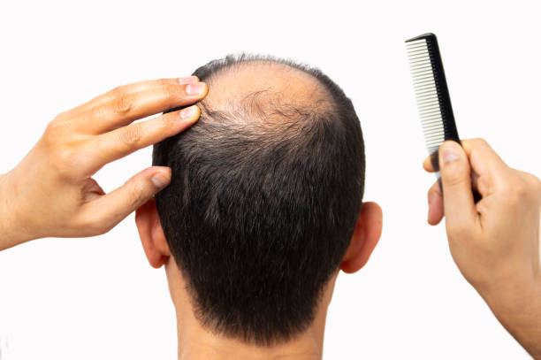 istock man concerned about his hair loss 1273657746
