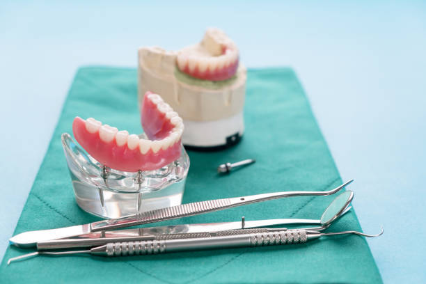 modello di denti che mostra un modello di ponte della corona implantare. - dental hygiene laboratory dental equipment technician foto e immagini stock