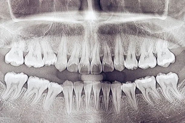 Photo of film x-ray of a mouth.