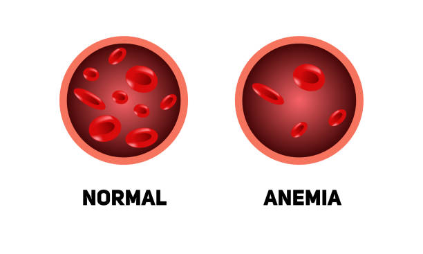 ilustrações de stock, clip art, desenhos animados e ícones de anemia, the blood of a healthy person and a blood vessel in anemia - blood cell anemia cell structure red blood cell