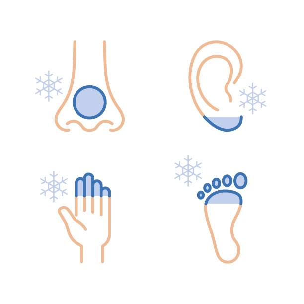 odmrożenie rąk, stóp, uszu i nosa. hipotermia. infografika medyczna - cold feet stock illustrations