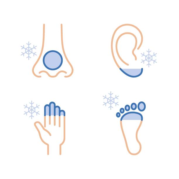 ilustrações de stock, clip art, desenhos animados e ícones de frostbite of hands, foot, ears and nose. hypothermia. medical infographic - congelação