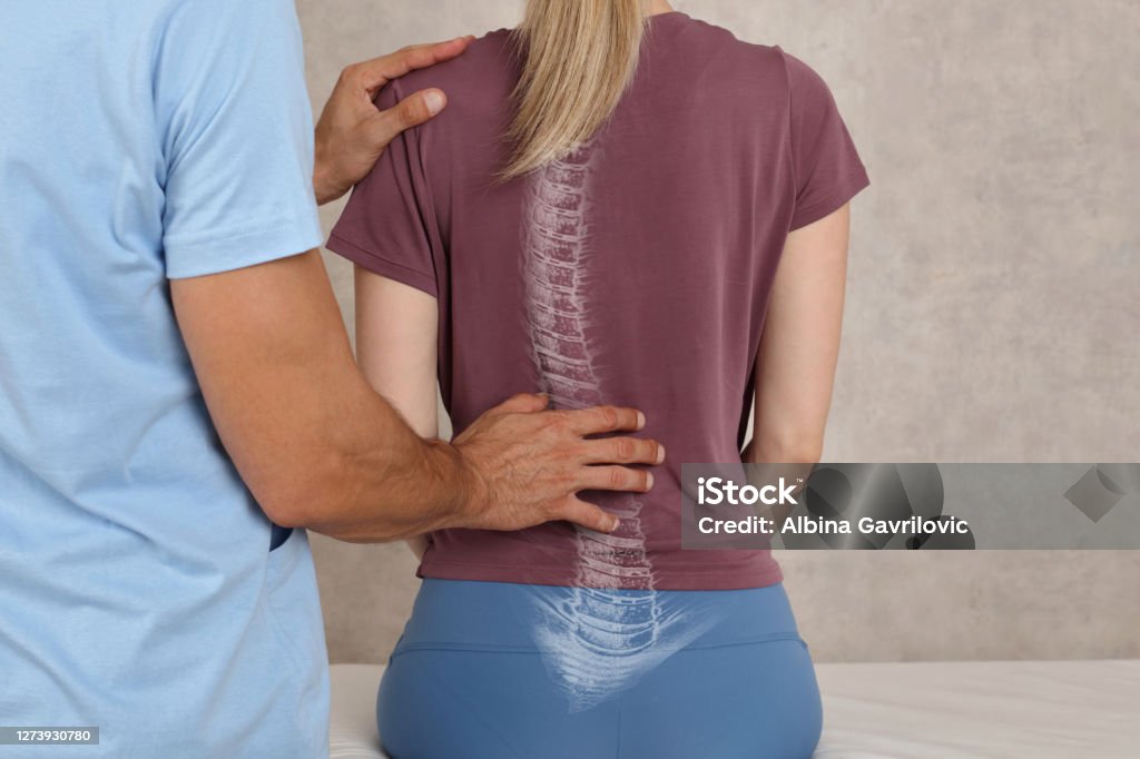 Scoliosis Spine Curve Anatomy, Posture Correction. Chiropractic treatment, Back pain relief. Scoliosis Stock Photo