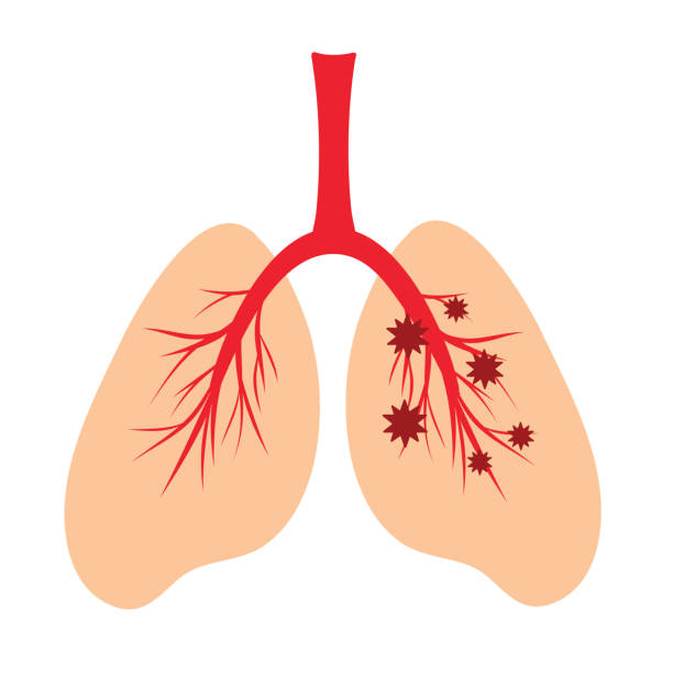 Human lungs, schematic illustration of human lungs infection with a virus. Anatomical structure of the human respiratory system. Virus trapped in the lungs, influenza coronavirus Human lungs, schematic color illustration of human lungs infection with a virus. Anatomical structure of the human respiratory system. Virus trapped in the lungs, influenza coronavirus clip art of a diagram of human lungs stock illustrations