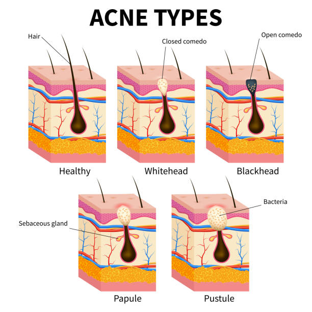 illustrazioni stock, clip art, cartoni animati e icone di tendenza di tipi di acne. diagramma vettoriale medico delle malattie della pelle brufoli - close cut