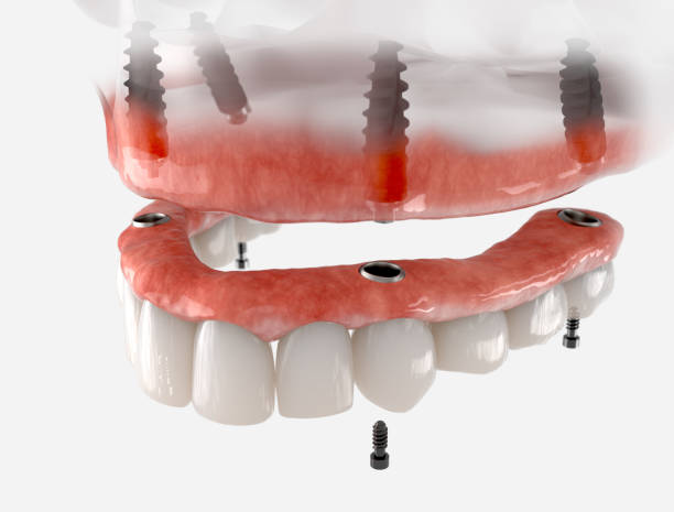 Maxillary Prosthesis 8,200+ Mandibular Prosthesis Stock Photos, Pictures & Royalty-Free ...