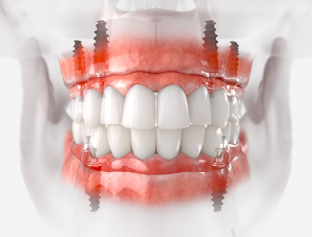 prótesis mandibular y maxilar - teeth implant fotografías e imágenes de stock