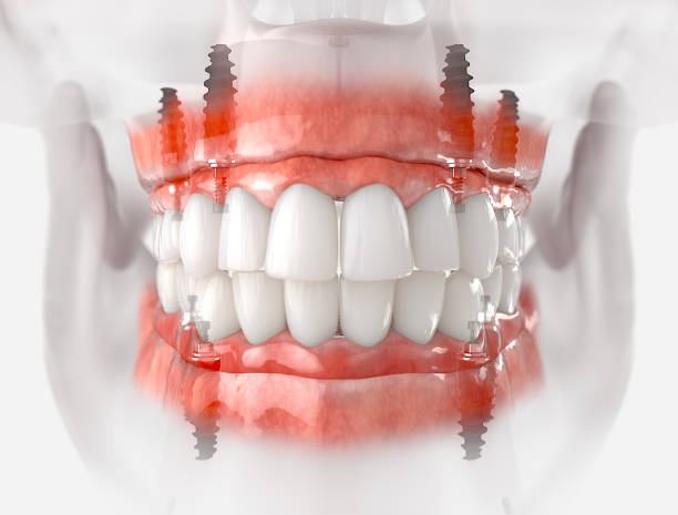 顎及び上顎の補用 - dental implant dental hygiene dentures prosthetic equipment ストックフォトと画像