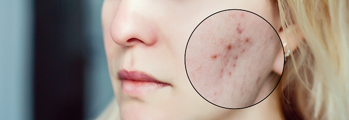 Young woman before and after anti acne treatment, skincare and dermatology concept, skin imperfections close up.